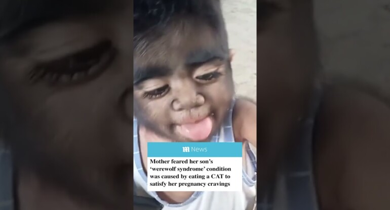 Mother fears her son's 'werewolf syndrome' condition was caused by EATING A CAT during pregnancy...😳