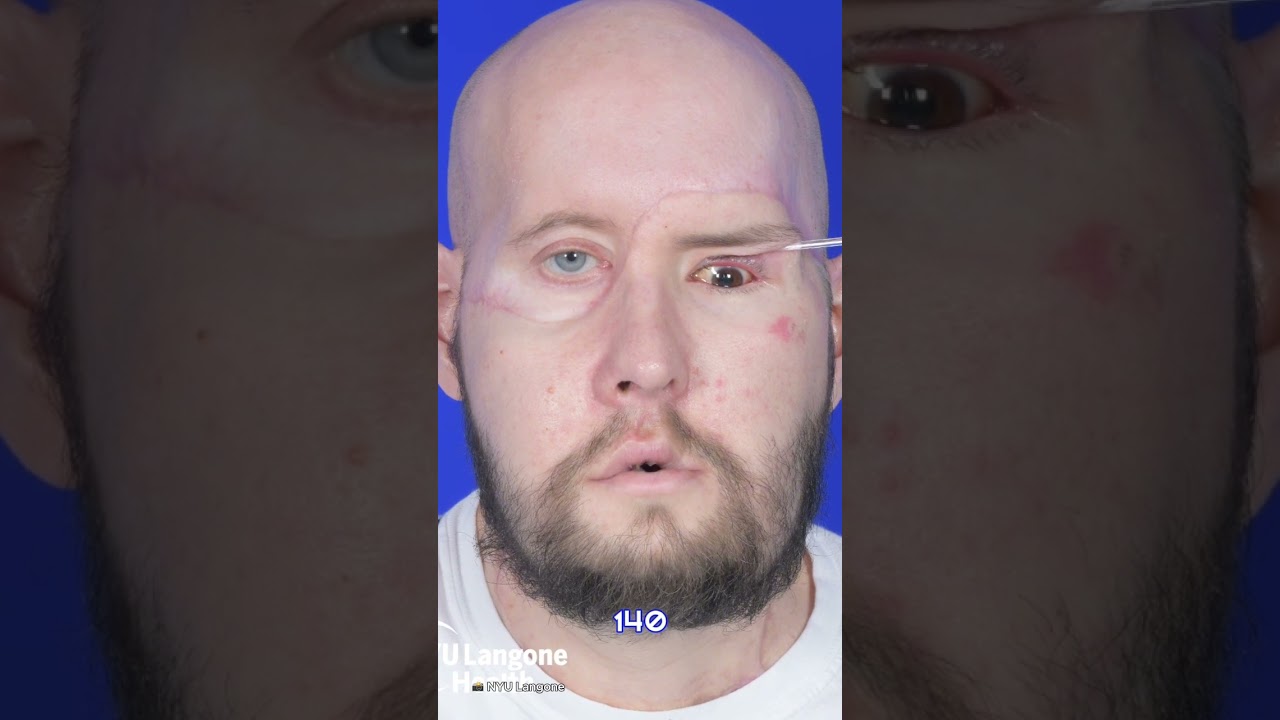 your local bury taxi september 10, 2024 first face and eye transplant patient shares 'emotional' kiss with wife