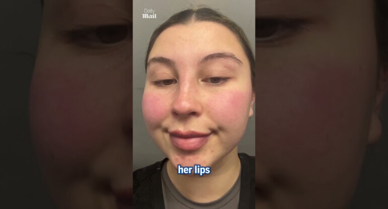 Lip tattoo gone wrong!